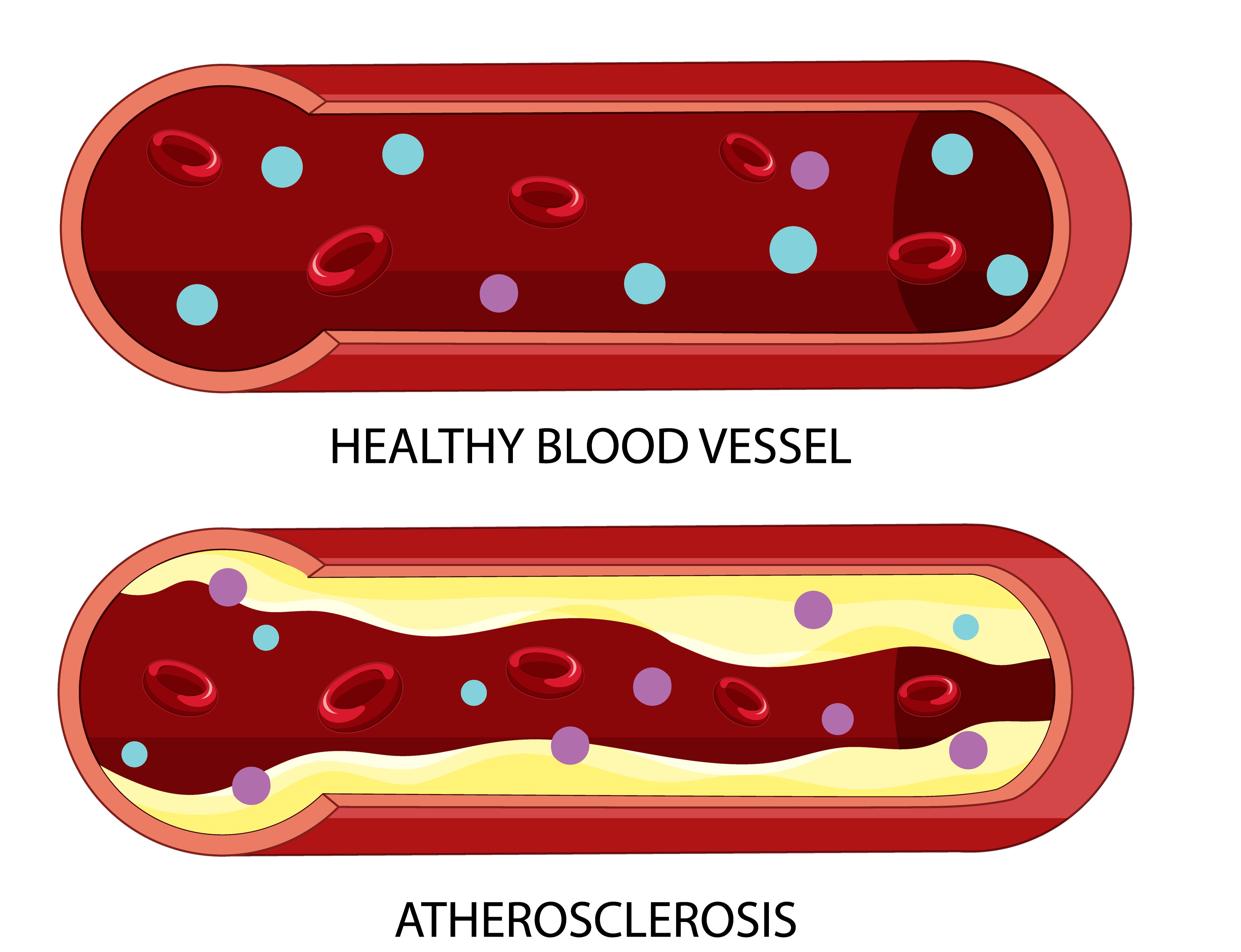 Atherosclerosis